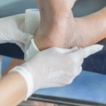 Chronic foot ulcers